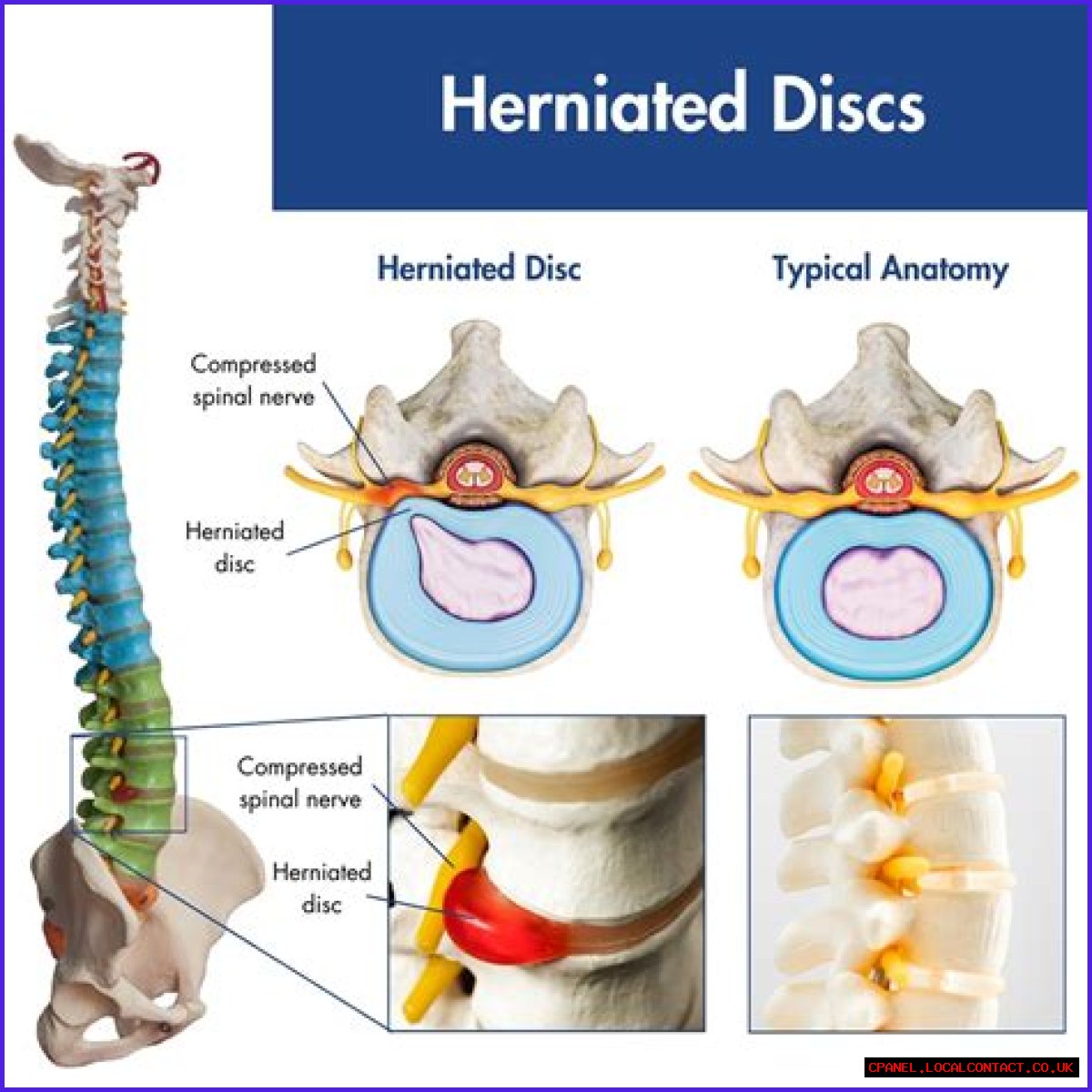 Is herniated disc painful?