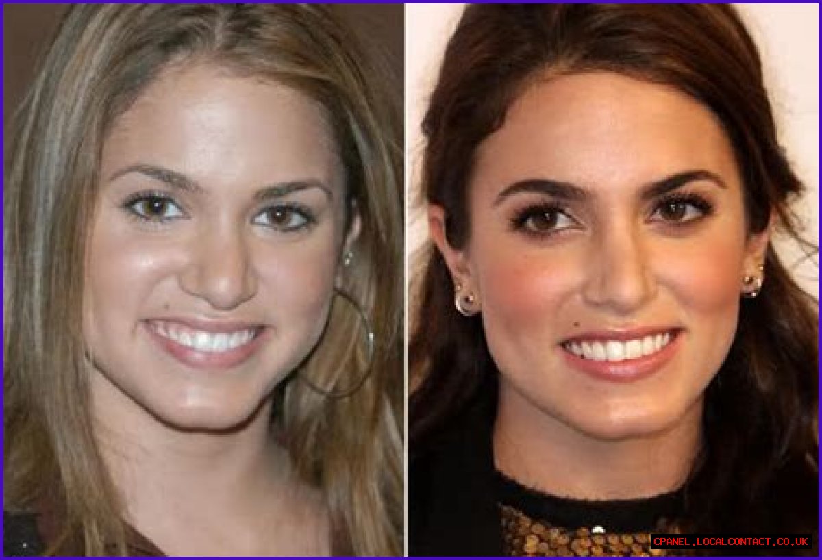 Nikki Reed Plastic Surgery Before and After