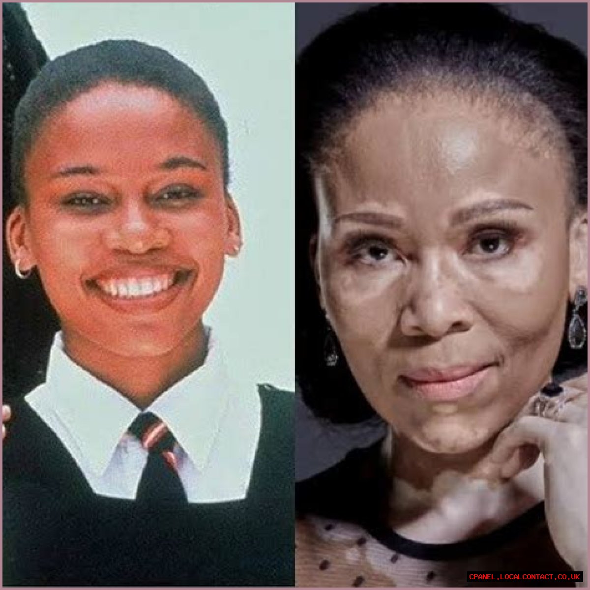 Sarafina Skin Condition: Understanding The Causes, Symptoms, And Treatments